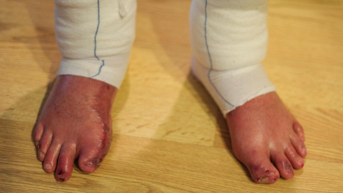 Pismo Beach firefighter Casey Allen was injured while battling the Dolan Fire near Big Sur, suffering second- and third-degree burns over more than 40% of his body. He has undergone a series of skin grafts.
