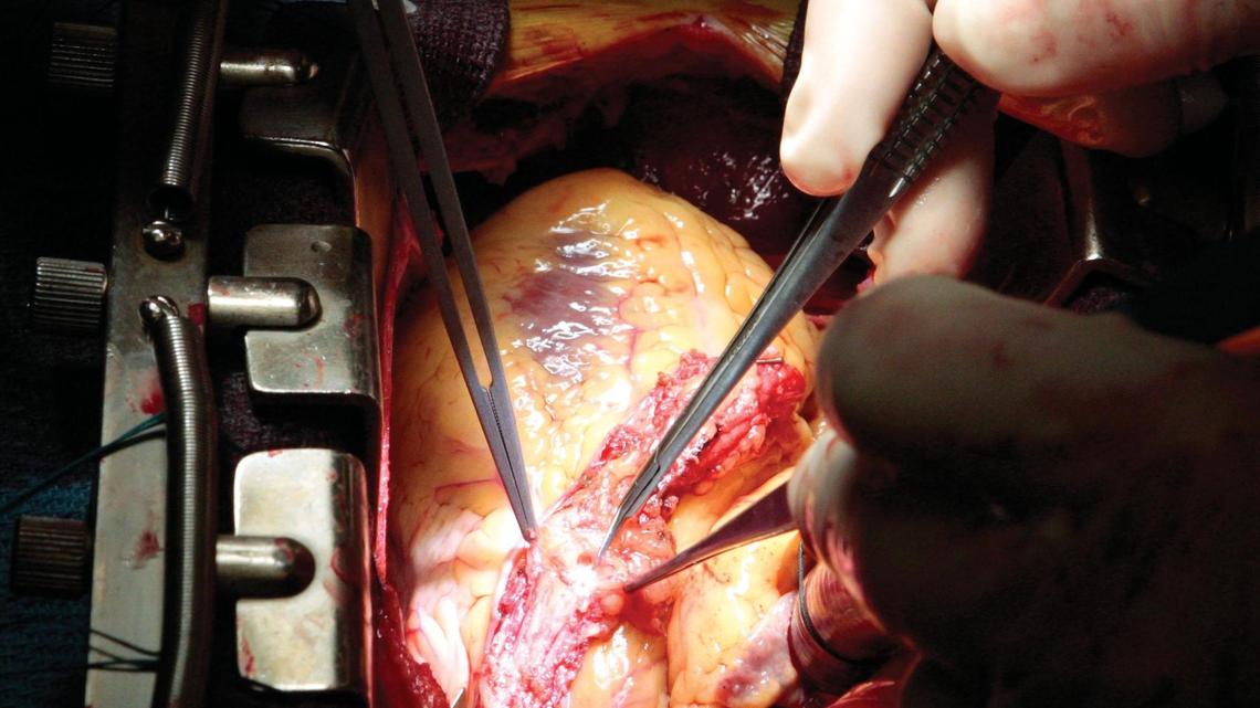 At right, French Hospital Medical Center cardiac surgeon Dr. Luke Faber prepares an artery rerouted from the chest wall to the heart for a double bypass of blocked heart arteries on June 25, 2008. The hand on the left belongs to Kathie Flynn, registered nurse.