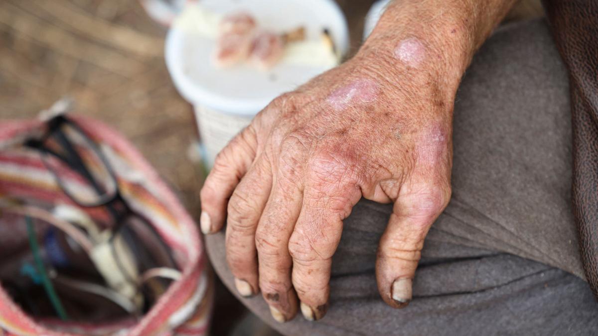Brad Dunlap said he doesn’t have major health issues but when asked in detail he was recovering from a staph infection on his hands and a neck injury that leaves him unable to straighten his head. He was on the Bob Jones Trail near San Luis Creek, a short distance from 40 Prado Homeless Services Center Oct. 9, 2024.