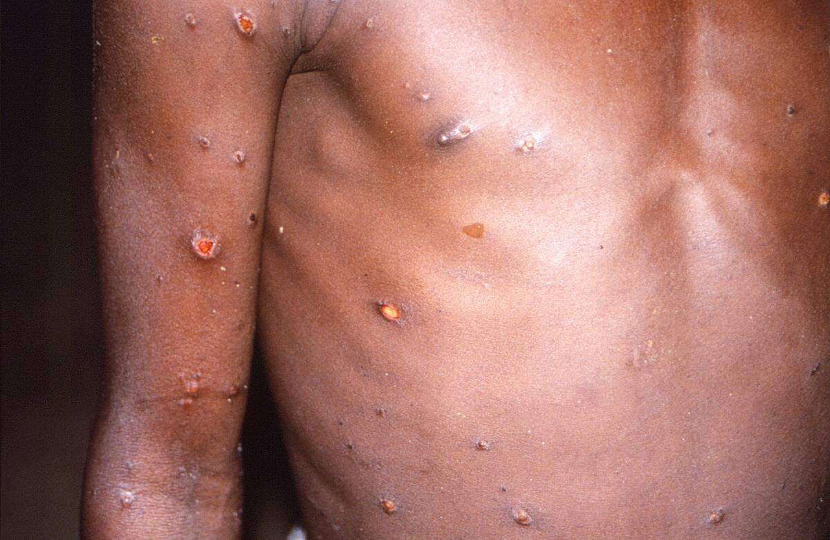 This 1997 image provided by CDC, shows the right arm and torso of a patient, whose skin displayed a number of lesions due to what had been an active case of monkeypox. As more cases of monkeypox are detected in Europe and North America in 2022, some scientists who have monitored numerous outbreaks in Africa say they are baffled by the unusual disease’s spread in developed countries.