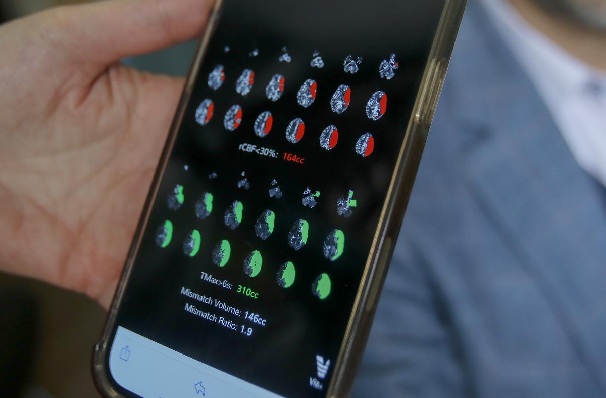 Sierra Vista Hospital is now using AI technology that can spot signs of a stroke in a patient’s CT scan results, then notifies all medical personal working with the patient with the information. This means doctors can respond to the stroke more quickly than before. The software can be viewed on a cell phone.