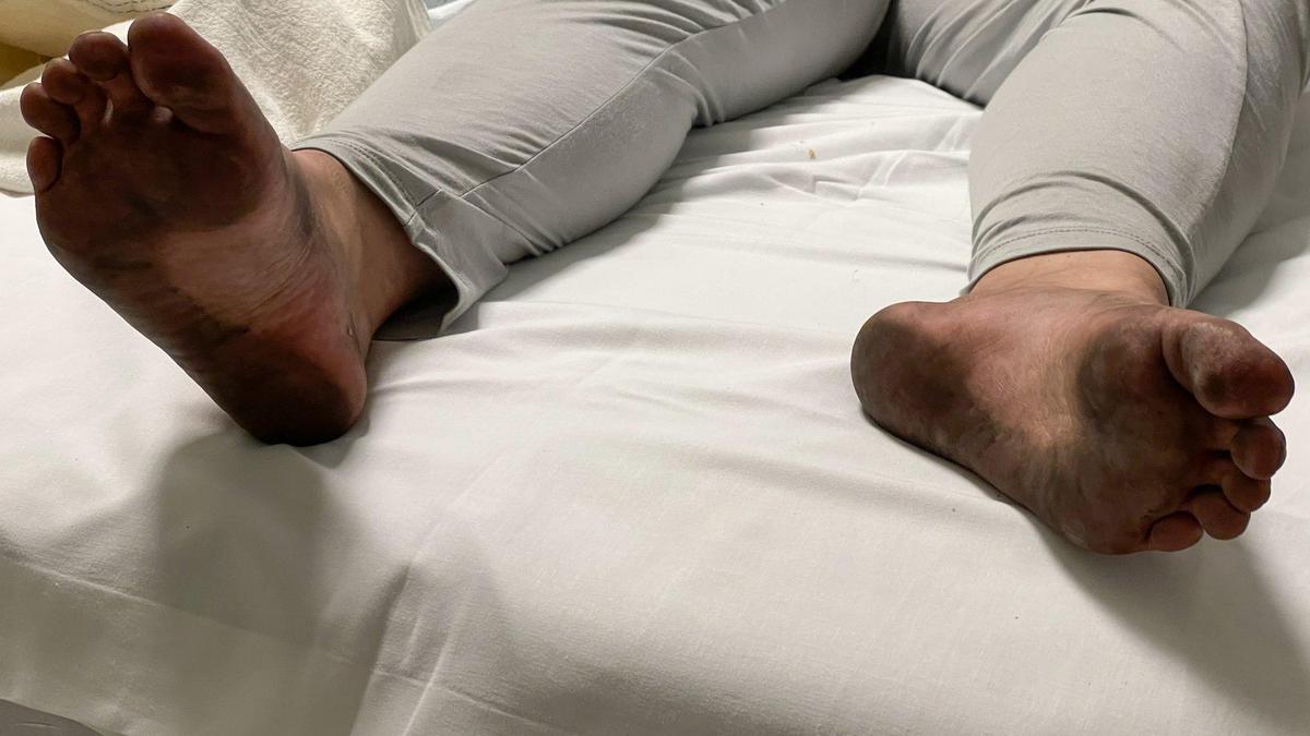 Ashlynn Miles during one of her hospital stays in October 2021 after she had been assaulted. Ashlynn prefers not to wear shoes even in cold.