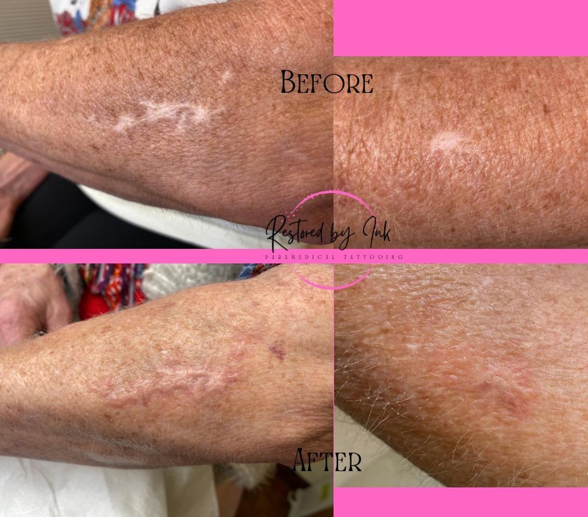 Monica Hollenbeck helps cancer survivors heal. As a paramedical tattoo artist she is trained in covering scar and stretch marks, camouflaging surgery and helping survivors regain a sense of normalcy.
