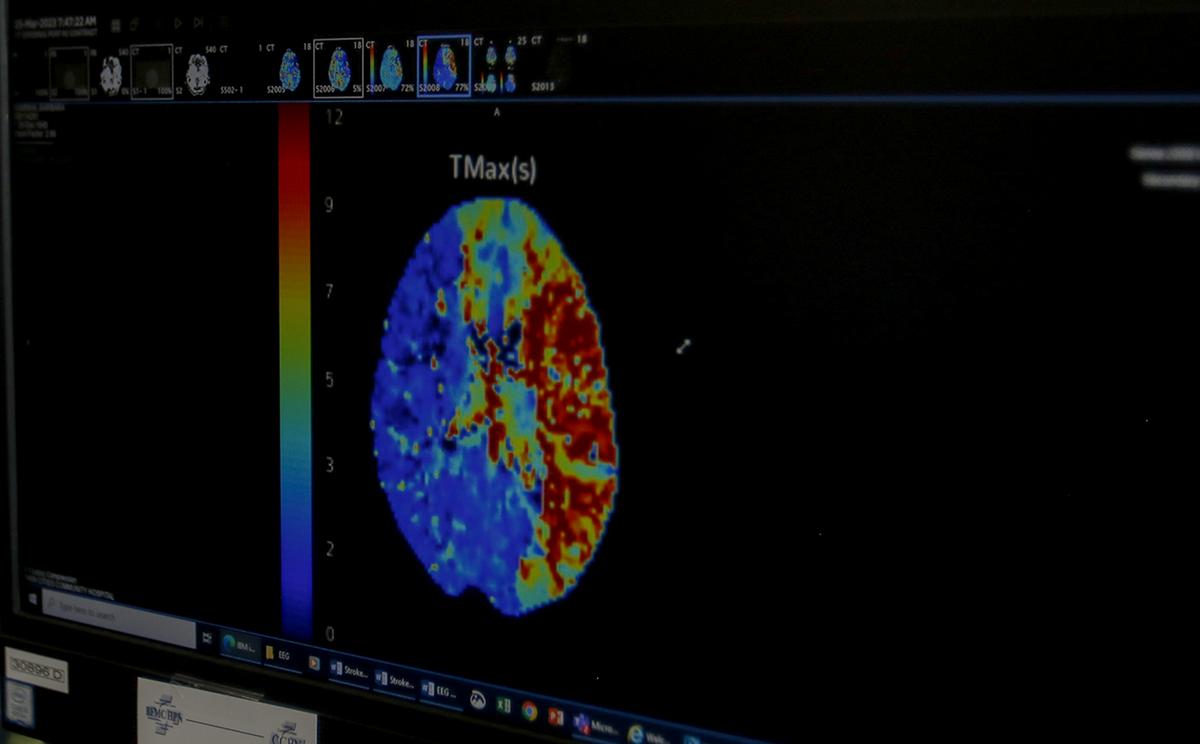 Sierra Vista Hospital is now using AI technology that can spot signs of a stroke in a patient’s CT scan results, then notifies all medical personal working with the patient with the information. This means doctors can respond to the stroke more quickly than before