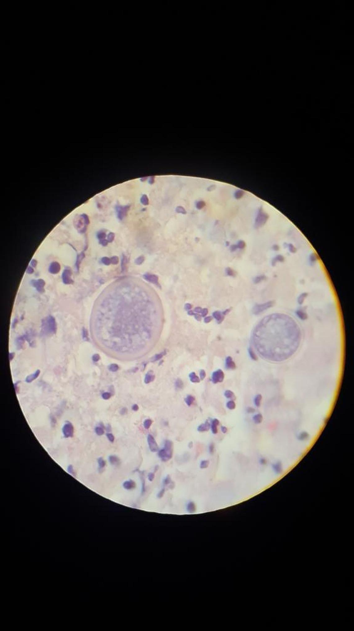 Coccidioides spherules are pictured here in a lung (the form of valley fever fungus seen in tissues).