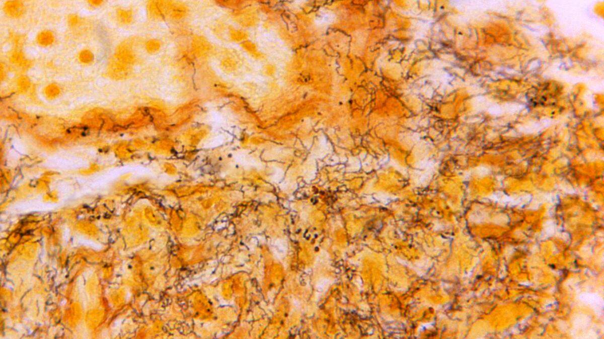 This 1966 microscope photo made available by the Centers for Disease Control and Prevention shows a tissue sample with the presence of numerous, corkscrew-shaped, darkly-stained, Treponema pallidum spirochetes, the bacterium responsible for causing syphilis.