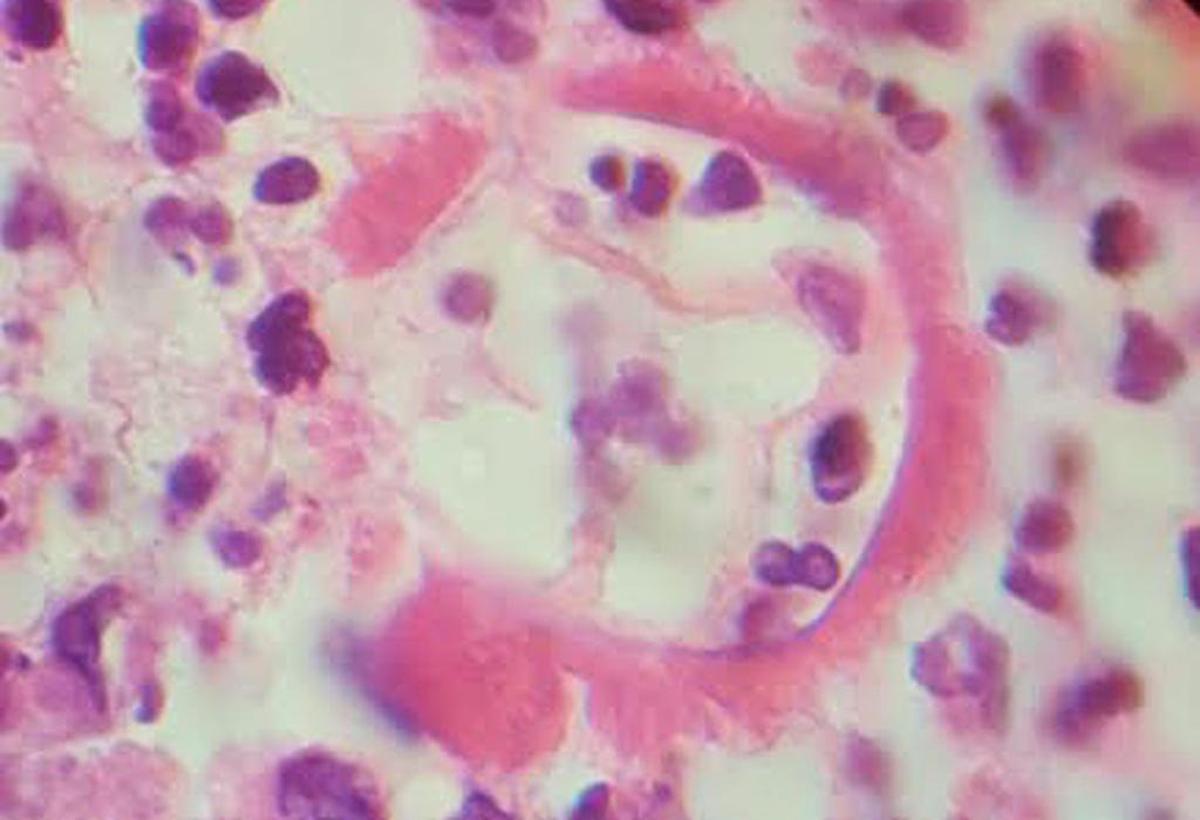 A microscopic image shows a cocci spherule being destroyed in the placenta of woman pregnant with twins who almost died from valley fever.