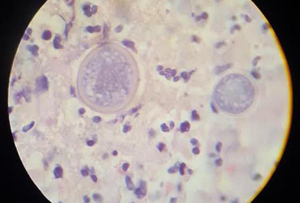 Cocci spherules, the fungus that causes valley fever, are seen under a microscope. The county is seeing record numbers of valley fever cases this year.