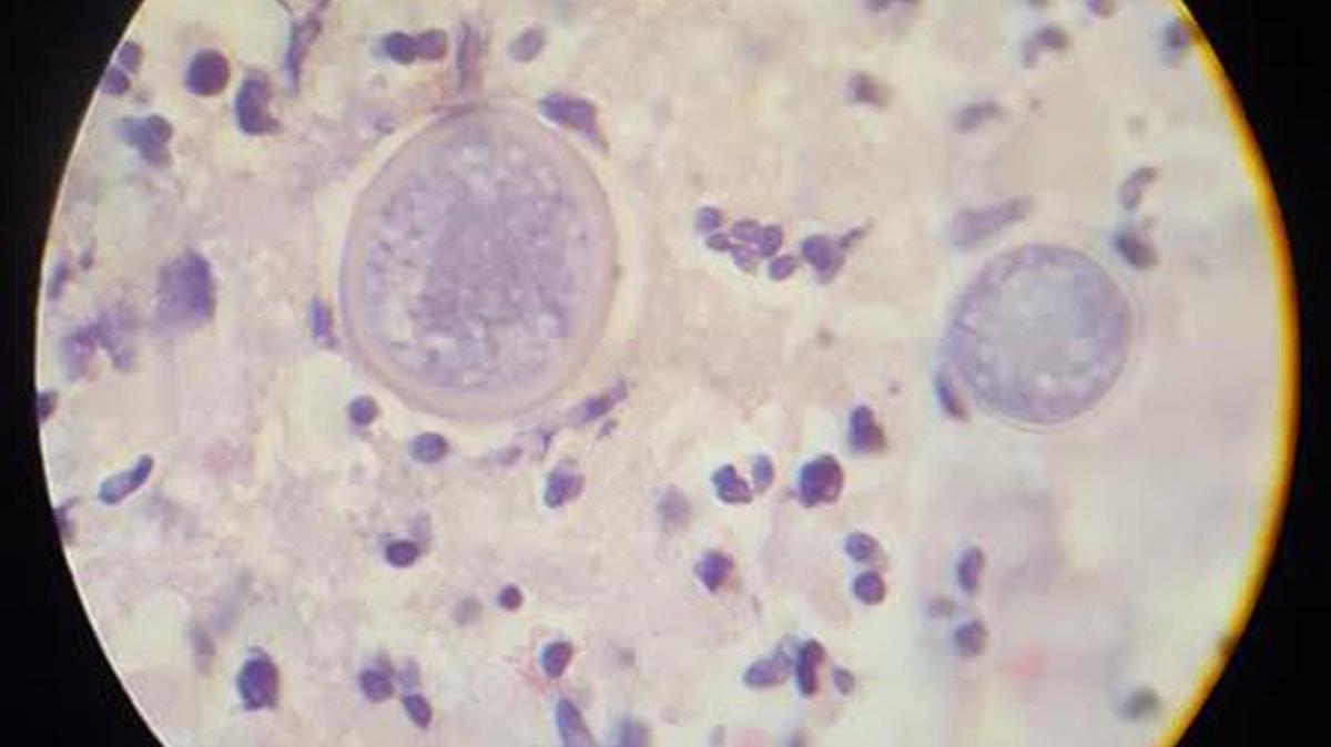 Cocci spherules, the fungus that causes valley fever, are seen under a microscope. The county is seeing record numbers of valley fever cases this year.