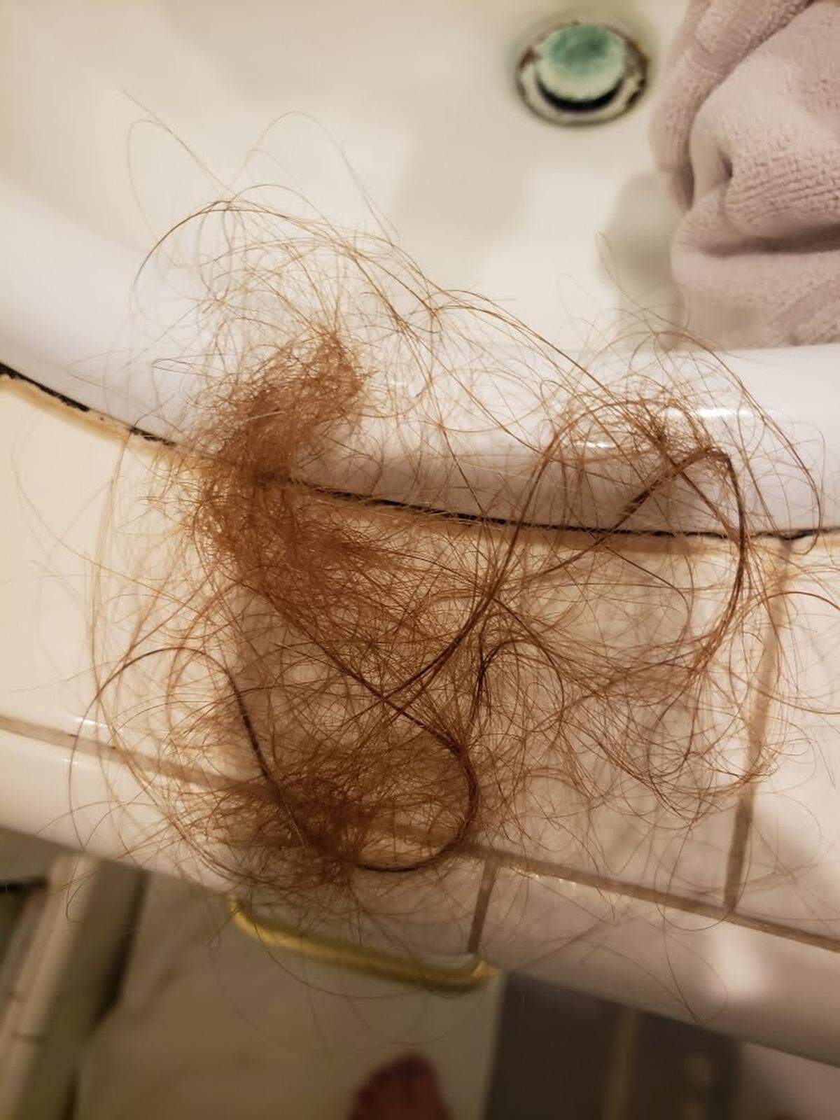 Despite a rigorous cold-capping routine, some of Lisa Lazzara’s hair did fall out during her chemotherapy treatment.